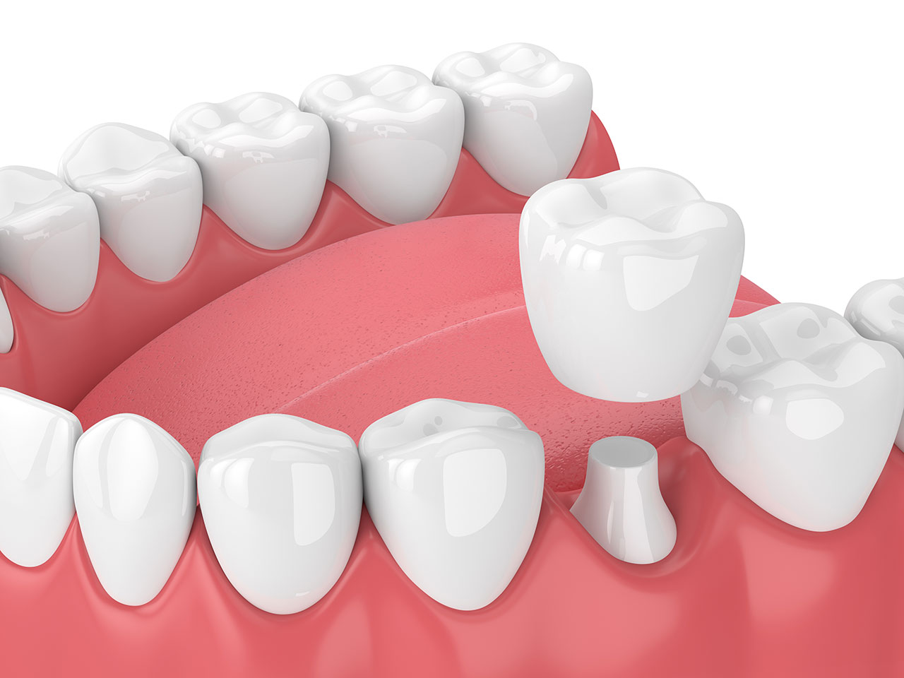 Do I Need a Dental Crown? 8 Signs Your Tooth May Need More Protection